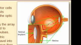 The Workings of the Retinal Prosthesis