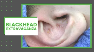 Blackhead Extravaganza | Dr. Derm