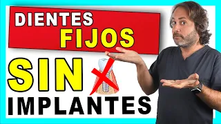 ¿𝗗𝗜𝗘𝗡𝗧𝗘𝗦 𝗙𝗜𝗝𝗢𝗦 𝗦𝗜𝗡 𝗜𝗠𝗣𝗟𝗔𝗡𝗧𝗘𝗦 dentales?👍 Lo ÚLTIMO en PUENTES DENTALES Fijos de Zirconio