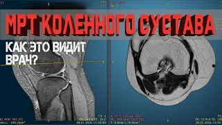 Разбор МРТ Коленного сустава. Что можно найти на снимке?