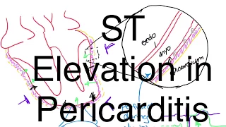 ST Elevation in Pericarditis