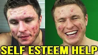 ACNE & DEPRESSION | What Can Help & My Story