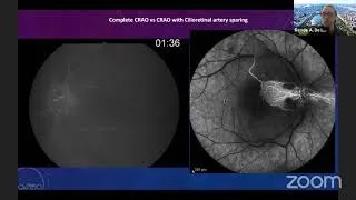 Central Retinal Artery Occlusion: Defining the Role of Neurointervention with Reade A. De Leacy, MD