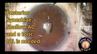 Cataract Surgery with Lysis of Posterior Synechiae and Pupil Restoration