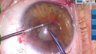 Secluded & Fibrotic Pupil: Two-Handed Pupillary Membrane Peel Technique. Soft Cataract, Iris Hooks