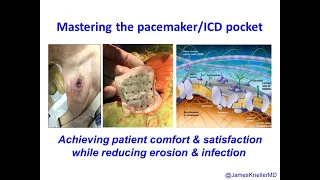 Mastering the Pacemaker/ICD pocket for patient satisfaction and to prevent infection