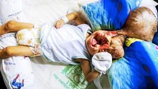 Baby Born Without a Face Survives and Did the Unthinkable