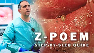 Z-POEM for Zenker's Diverticulum: A Step-by-Step Guide to This Innovative Technique