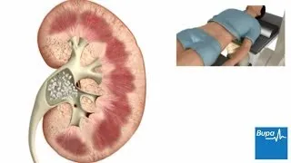 How extracorporeal shockwave lithotripsy is used to treat kidney stones