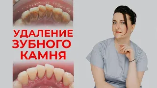 Как удалить зубной камень? / Профессиональная гигиена полости рта