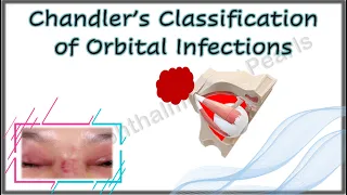 Chandler’s Classification of Orbital Infections