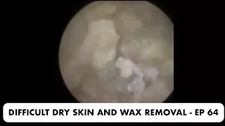 DIFFICULT DRY SKIN AND EAR WAX REMOVAL - EP 64