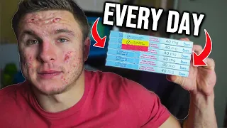 I Took The World's Highest Dose of Accutane & What Happened...