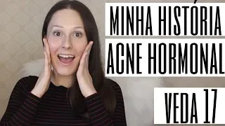 VEDA/17 - Como ACABEI com a ACNE HORMONAL?