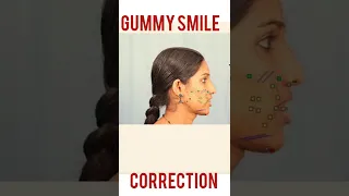 Gummy Smile Correction In India - Best Result After Surgery | Dr Mathew PC #shorts
