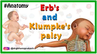 Erb's palsy and klumpke's palsy USMLE Animation - Etiology, Clinical features, Diagnosis, Treatment