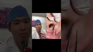 #shorts Reacting to a Dilated Pore Extraction