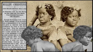 The Conjoined Carolina Twins | Millie Christine McKoy | Quick & Weird History