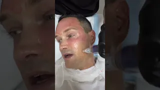 Getting A PRP Vampire Facial