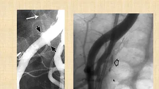 Ureteral Stents: Complications and Innovations