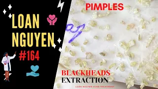 Happy Mother's Day with blackheads watch (164) | Loan Nguyen