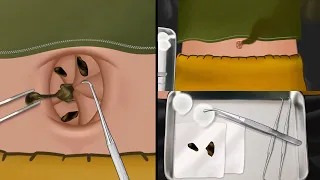 ASMR Satisfying navel stone removal animation! Part 2