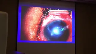 pediatric uveitis Quan Dong Nguyen, USA