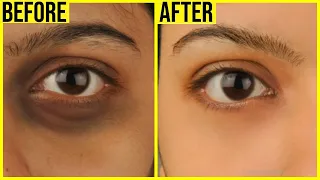 How to Remove Dark Circles Naturally in 3 Days (100% Results)