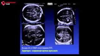 Возможности ультразвуковой диагностики агенезии мозолистого тела плода - М.А. Эсетов