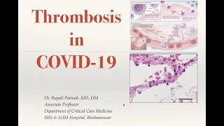 Thrombosis in COVID 19: Pathophysiology and Management