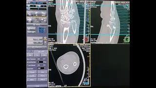 شرح فحص الاشعه المقطعيه علي الرسغ / CT Wrist scan