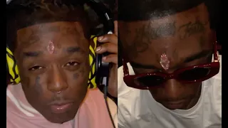 Lil Uzi Vert Face Swolen After Getting $24M Diamond Installed In Forehead