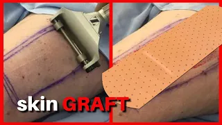 How To Skin Graft ✂️#shorts