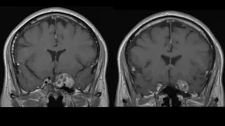 Endoscopic Endonasal Surgery for Recurrent Sellar-Cavernous Sinus Craniopharyngioma at Stanford