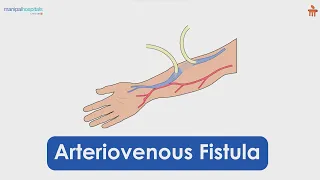 Arteriovenous Fistula | Manipal Hospitals Bengaluru