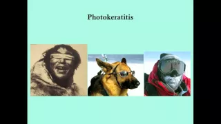 Photokeratitis- CRASH! Medical Review Series