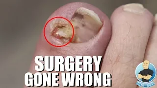 SOMETHING WAS LEFT BEHIND ***INGROWN SURGERY FAILED***