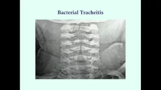 Bacterial Tracheitis - CRASH! Medical Review Series