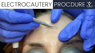 Watch an Electrocautery Procedure