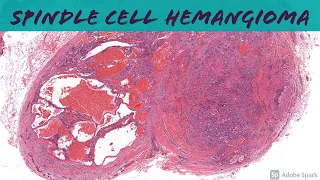 Spindle Cell Hemangioma 101