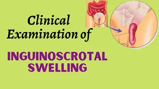 Clinical Examination of Inguinoscrotal Swelling | Surgery Video | MedVids Planet