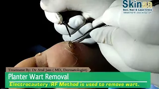 Plantar Wart Removal Treatment With Electrocautery or RF Method | Skinaa Clinic, Jaipur