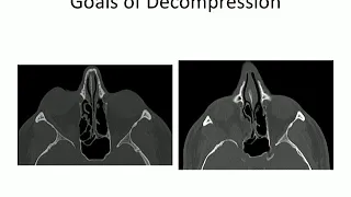 Advanced Concepts in Orbital Decompression Surgery
