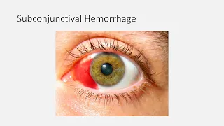 Ophthalmology Summary for MRCEM intermediate SBA