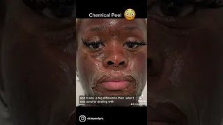 Chemical Peel (Elaine Brennan Skin Renewal)