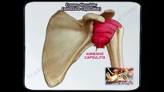 Frozen Shoulder Adhesive Capsulitis - Everything You Need To Know - Dr. Nabil Ebraheim