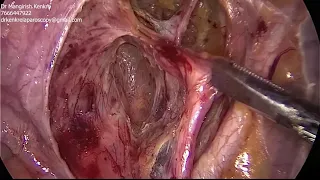 Okabayashi's Space (Medial Para Rectal Space) and Inferior Hypogastric Nerve