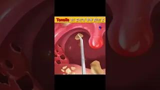 Tonsils का इलाज कैसे होता है || Treatment of Tonsils Animation || Prateek || Medical Mitra