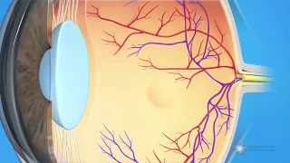 What is dry age-related macular degeneration (AMD)?