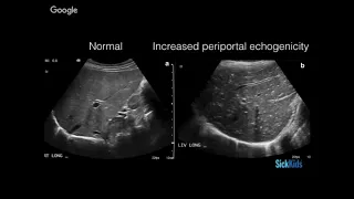 Appendicitis Update (2/5)